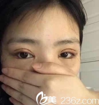 长治悦美薛艳峰院长给我做全切双眼皮和开眼角术后第3天照片 长治悦美薛艳峰院长给我做全切双眼皮和开眼角术后第3天照片