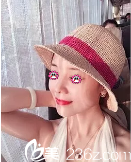 北京米扬丽格巫文云自体软骨鼻综合隆鼻案例