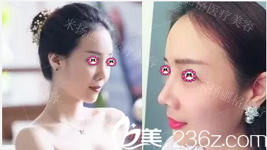北京米扬丽格找巫文云做隆鼻前后对比效果
