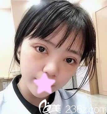 长治悦美薛艳峰给我做切开双眼皮加开内眼角术后第7天拆线照片 长治悦美薛艳峰给我做切开双眼皮加开内眼角术后第7天拆线照片