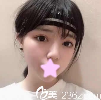 不知道和悦美哪个医院好？冲着悦美整形价格实惠找薛艳峰做了全切双眼皮+开眼角