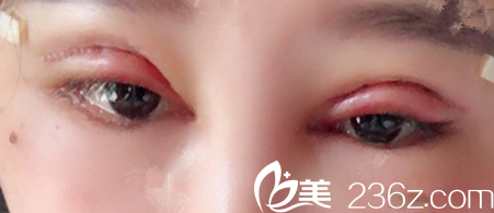 找合肥艾雅整形陆玉定做眼部失败修复术后第3天照片 找合肥艾雅整形陆玉定做眼部失败修复术后第3天照片
