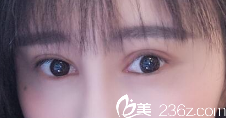 陆玉定做失败双眼皮修复术后第15天恢复情况 陆玉定做失败双眼皮修复术后第15天恢复情况