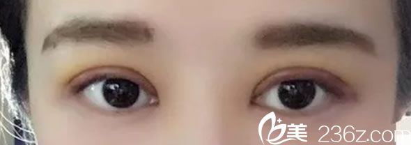 割双眼皮第三天恢复效果 割双眼皮第三天恢复效果