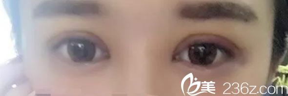 全切双眼皮第7天恢复效果图 全切双眼皮第7天恢复效果图