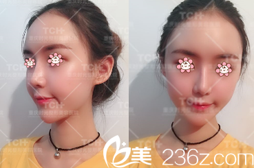 重庆时光哪个医生做假体隆下巴好 重庆时光哪个医生做假体隆下巴好