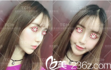 重庆时光孔令杰做假体隆鼻怎么样 重庆时光孔令杰做假体隆鼻怎么样