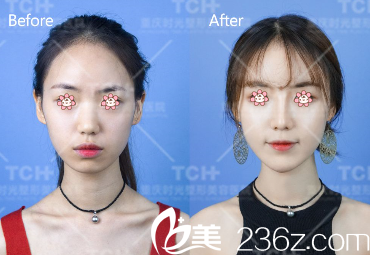 孔令杰院长假体隆鼻案例 孔令杰院长假体隆鼻案例