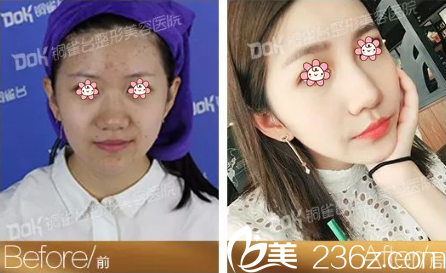 怎样祛痘才有效？分享重庆铜雀台痘痘粉刺困扰者小饶的祛痘净白过程。