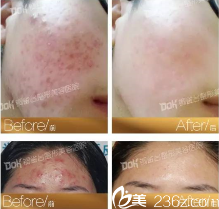 重庆铜雀台祛痘怎么样