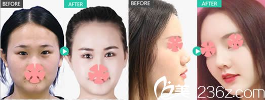 切开双眼皮和鼻综合隆鼻前后对比效果图