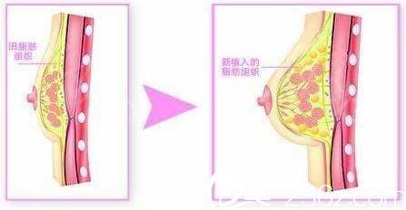 韩国Cara整形外科假体隆胸 韩国Cara整形外科假体隆胸