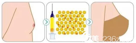 韩国Cara整形外科金贤秀自体脂肪隆胸