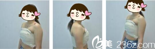 韩国Cara整形外科金贤假体隆胸真人案例术后第三天 韩国Cara整形外科金贤假体隆胸真人案例术后第三天