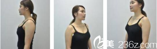 韩国Cara整形外科金贤假体隆胸真人案例术后十五天 韩国Cara整形外科金贤假体隆胸真人案例术后十五天