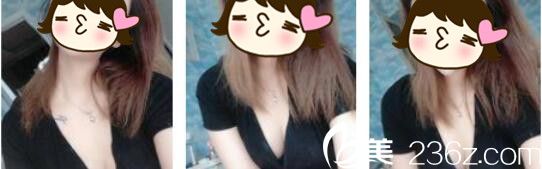 韩国Cara整形外科金贤假体隆胸真人案例术后二十一天 韩国Cara整形外科金贤假体隆胸真人案例术后二十一天