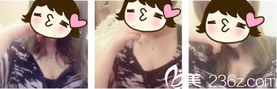 胸下垂的我去韩国Cara找金贤秀做假体隆胸，让胸部重新二次发育起来