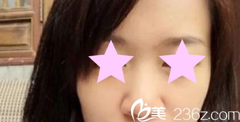 韩国爱她整形外科医院手术前 韩国爱她整形外科医院手术前