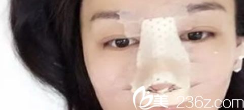 隆鼻手术第2天 隆鼻手术第2天