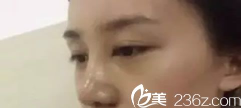 鼻子做完假体9天恢复图 鼻子做完假体9天恢复图