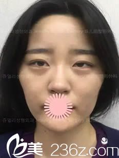 韩国珠儿丽整形医院自体脂肪面部填充术前照 韩国珠儿丽整形医院自体脂肪面部填充术前照