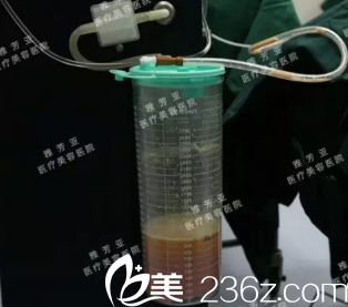 在雅芳亚做大腿环吸2000cc脂肪量 在雅芳亚做大腿环吸2000cc脂肪量
