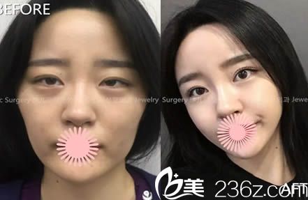 韩国珠儿丽面部脂肪移植效果对比图 韩国珠儿丽面部脂肪移植效果对比图