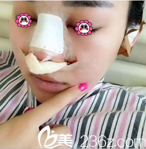 我在北京米扬丽格做隆鼻当天样子