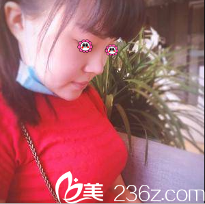 北京米扬丽格膨体+耳软骨鼻综合隆鼻案例