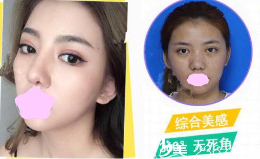 壹美尚李东霖蒙特鼻鼻综合整形案例 壹美尚李东霖蒙特鼻鼻综合整形案例