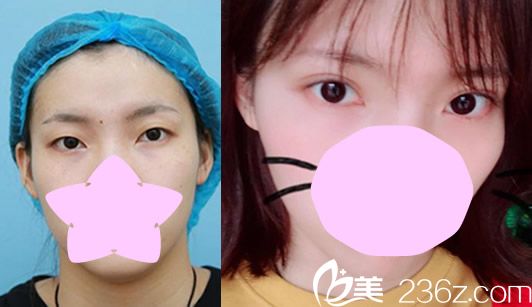 李东霖全切双眼皮整形案例 李东霖全切双眼皮整形案例