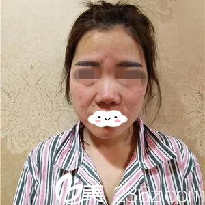 隆鼻前的我 隆鼻前的我