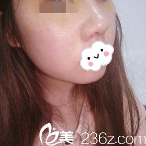 自体软骨隆鼻第8天 自体软骨隆鼻第8天