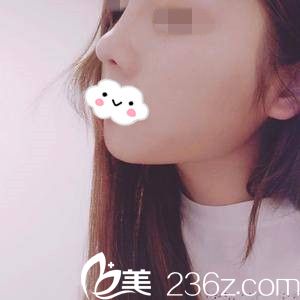 隆鼻半个月后的效果 隆鼻半个月后的效果