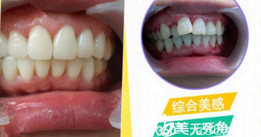 秦洪章牙齿半隐形矫正案例 秦洪章牙齿半隐形矫正案例