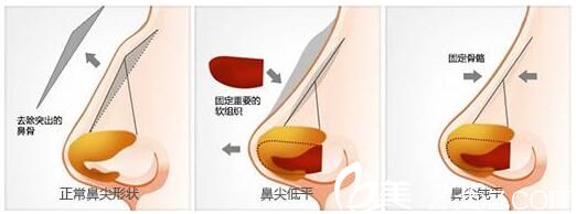 韩国AURORA整形外科医院李志永鹰钩鼻矫正 韩国AURORA整形外科医院李志永鹰钩鼻矫正
