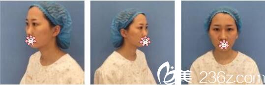 韩国AURORA整形外科医院李志永鼻综合真人案例术前照 韩国AURORA整形外科医院李志永鼻综合真人案例术前照