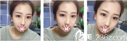 韩国AURORA整形外科医院李志永鼻综合真人案例术后十八天 韩国AURORA整形外科医院李志永鼻综合真人案例术后十八天