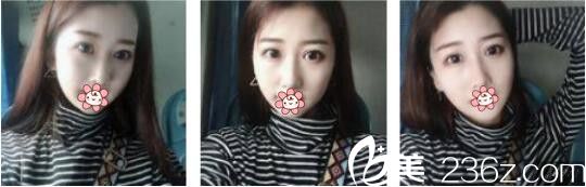 韩国AURORA整形外科医院李志永鼻综合真人案例术后一个月 韩国AURORA整形外科医院李志永鼻综合真人案例术后一个月