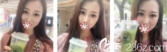 诉说我去韩国AURORA找李志永做鼻综合三个月的恢复心里路程