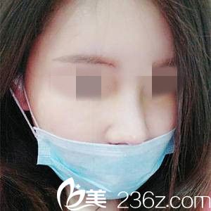 鼻修复一周后的效果