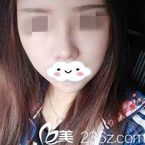 鼻修复术后半个月