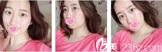 韩国奥拉克皮肤科整外科李正馥面部提升真人案例术前照 韩国奥拉克皮肤科整外科李正馥面部提升真人案例术前照