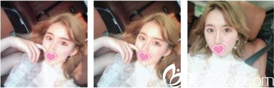 韩国奥拉克皮肤科整外科李正馥面部提升真人案例术后第七天 韩国奥拉克皮肤科整外科李正馥面部提升真人案例术后第七天