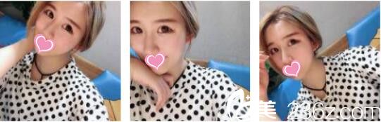 韩国奥拉克皮肤科整外科李正馥面部提升真人案例术后一个月 韩国奥拉克皮肤科整外科李正馥面部提升真人案例术后一个月