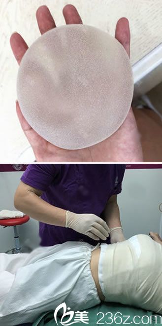 做隆胸假体和刚做完的照片 做隆胸假体和刚做完的照片