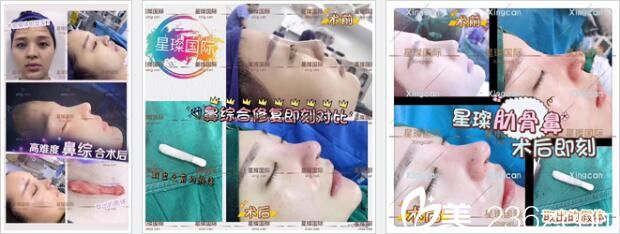 上海星璨整形医院鼻部整形真人案例2