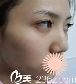 韩国枓翰整形外科面部填充术前照 韩国枓翰整形外科面部填充术前照