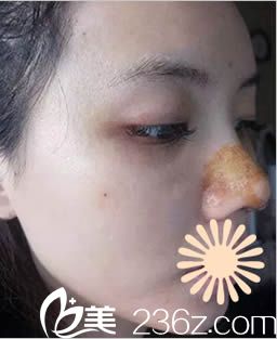 韩国枓翰整形鼻综合术后5天照 韩国枓翰整形鼻综合术后5天照