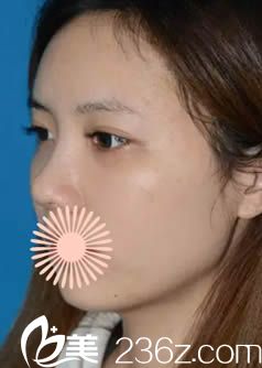 韩国申枓翰医生做面部脂肪填充和鼻综合术后15天照 韩国申枓翰医生做面部脂肪填充和鼻综合术后15天照